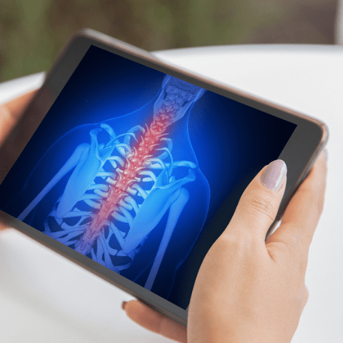 Innovations in Spine Surgery: AI Personalized Implants for Fusions